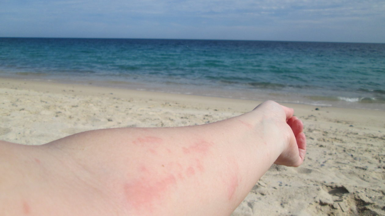 Jellyfish welts on a swimmer's arm